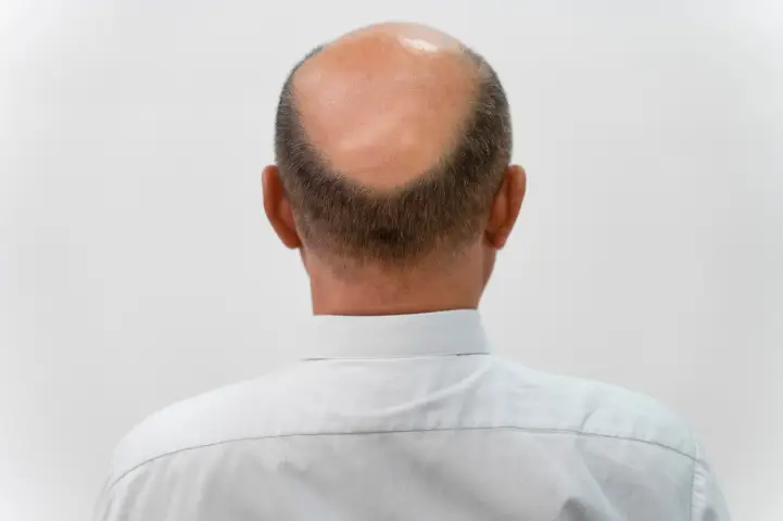 禿頭的前兆徵兆：揪出你的掉髮危機！